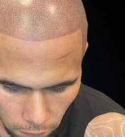 Scalp Micropigmentation in Chicago